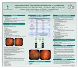 Atypical Bilateral Panuveitis Secondary to Toxoplasmosis